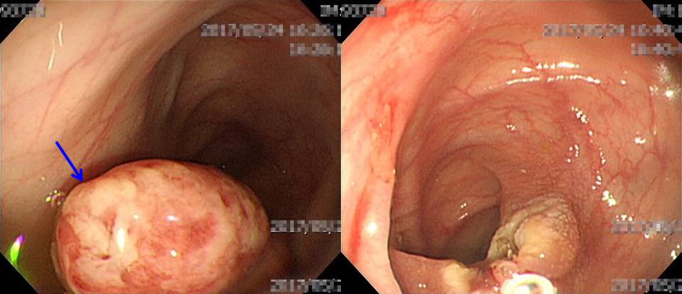 兒童大腸鏡發現0.8公分的息肉（左圖藍箭頭處），是造成女童血便原因，右圖為切除後。圖／新竹馬偕醫院提供