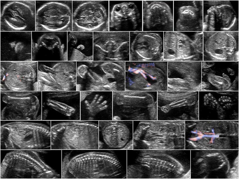 第二孕期胎兒常規超音波剖面圖，有經驗的產科醫師要把這些剖面圖在腦裡重組，以判斷胎兒的狀況。圖／吳佩臻醫師提供