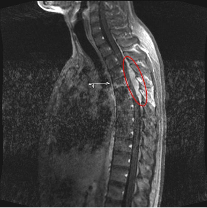 一名20多歲年輕男性在短短1周內突然癱瘓，核磁共振顯示胸椎第4、5節(紅圈處)有惡性腫瘤壓迫。圖／新竹馬偕醫院