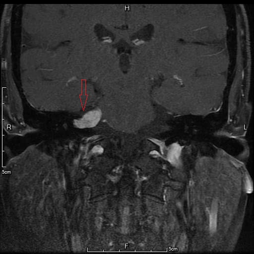 一名婦人因右耳耳鳴、聽力障礙就醫，檢查發現是聽神經瘤（箭頭處）作崇。圖／台大醫院新竹分院提供