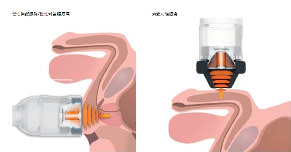 低能量體外震波可運用於泌尿科治療血管性勃起功能障礙。圖／張宏江醫師提供