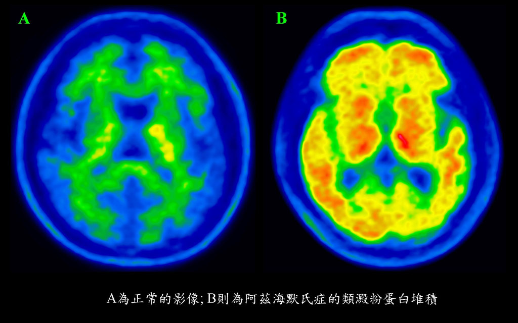 影像圖中的紅色區塊就是類澱粉蛋白堆積的顯影，Florbetaben是檢測阿茲海默症的試劑，即使是過去在透過臨床問診及檢查無法診斷的非典型阿茲海默症，經由Amyloid PET也可清楚確診。圖／王志偉翻攝