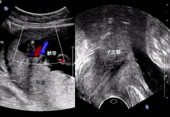 前置血管是指胎兒血管行走在子宮頸內口處，擋在寶寶的頭前方，（左為前置血管，右為正常）。圖／國泰醫院提供