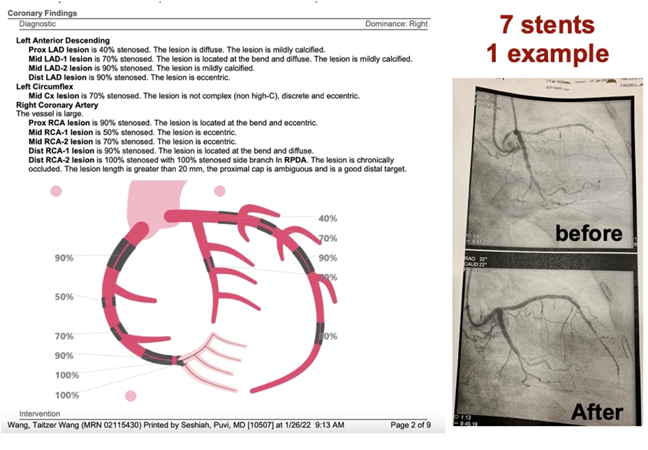 圖左：Dr. Puvi Seshiah 繪製心血管多處堵塞程度（深黑部分）；圖右：Dr. Jarrod D. Frizzell 七處成功氣球心導管手術一例。示意圖／王泰澤提供